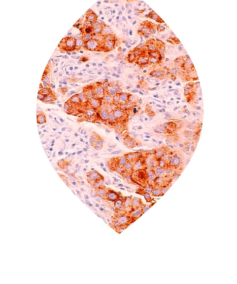 Tumor tissue under microscope - PATH - Patients' Tumor Bank of Hope - patient-driven non-profit tumor biobank that supports breast cancer research