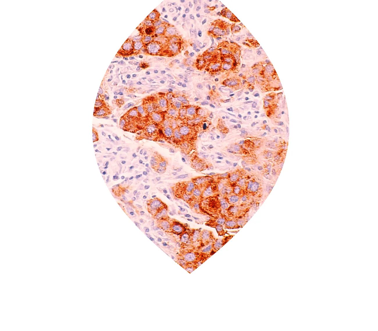 Tumor tissue under microscope - PATH - Patients' Tumor Bank of Hope - patient-driven non-profit tumor biobank that supports breast cancer research